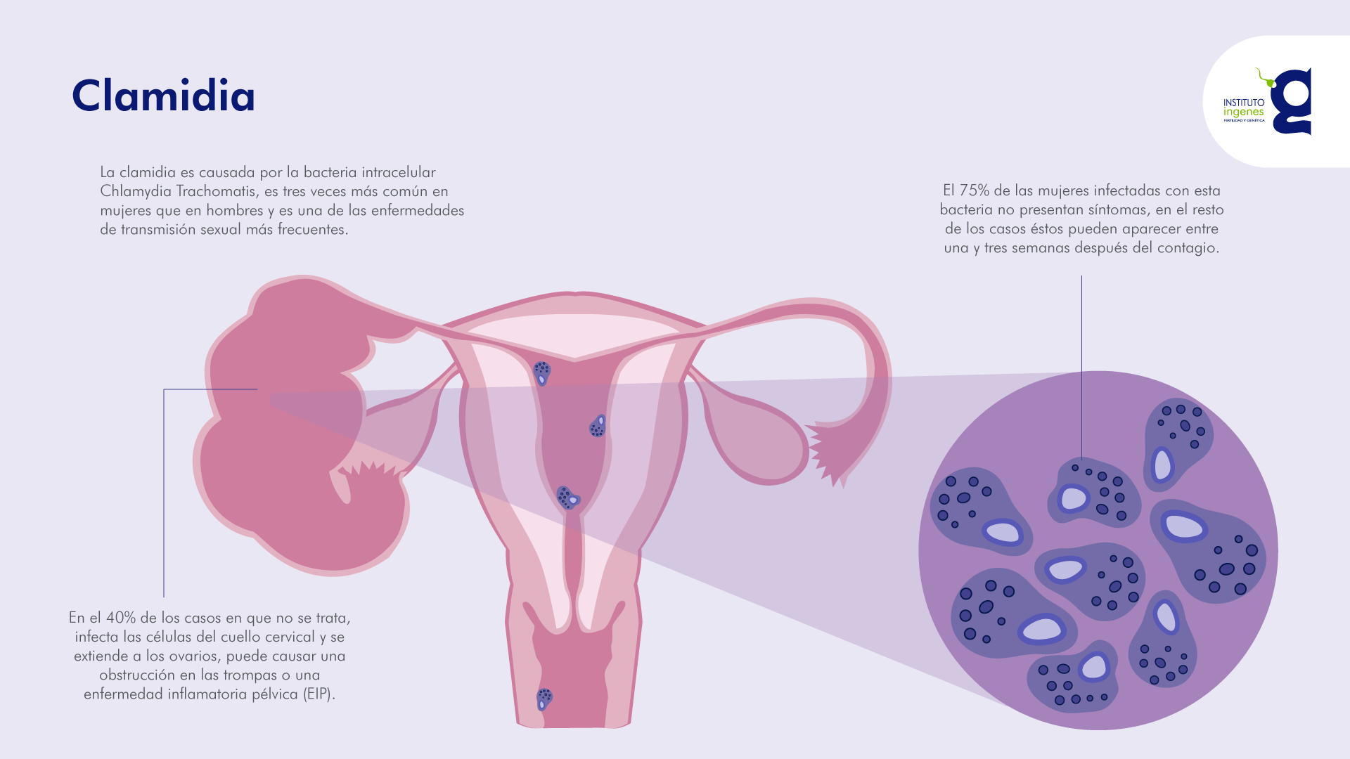 clamidia-clinicas-de-infertilidad-ingenes-reproduccion-asistida-información-sobre-clamidia-con-imagen-de-utero-presentando-este-problema-de-salud-reproductiva