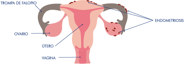 endometriosis-que-es-imagen-de-sitios-mas-frecuentes-donde-suele-desarrollarse-el-tejido-endometrial