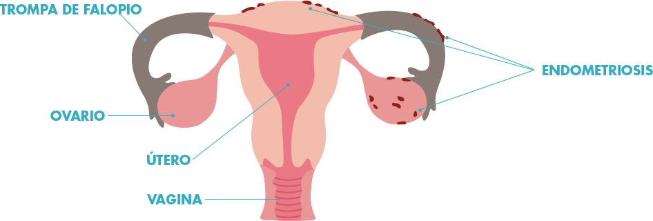 vínculo entre la endometriosis y la infertilidad