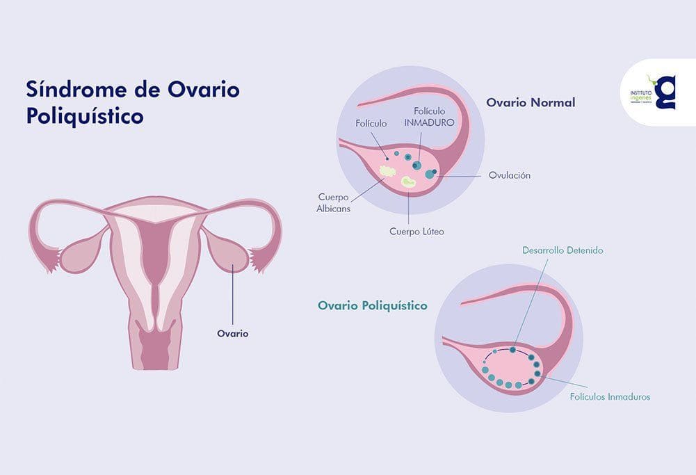 Síndrome de ovario poliquístico