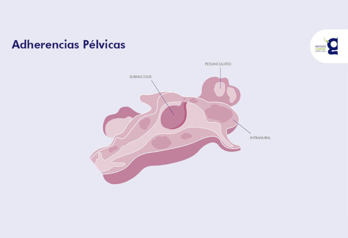 adherencias-pelvicas-y-como-afectan-tu-fertilidad