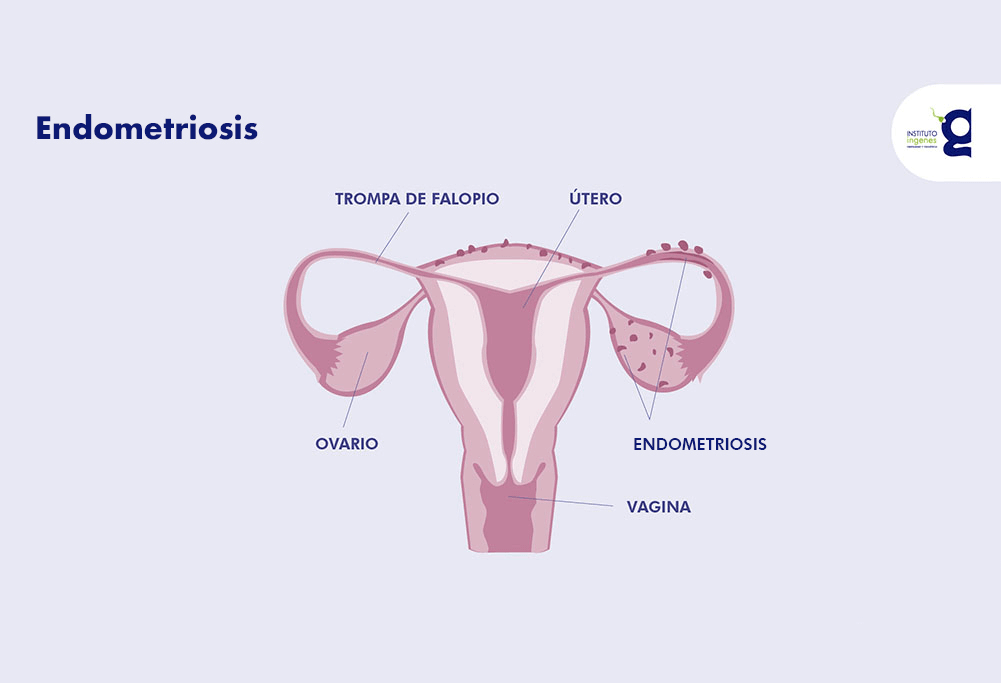endometriosis 1