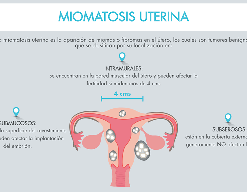clasificacion-de-miomas-uterinos-800x621
