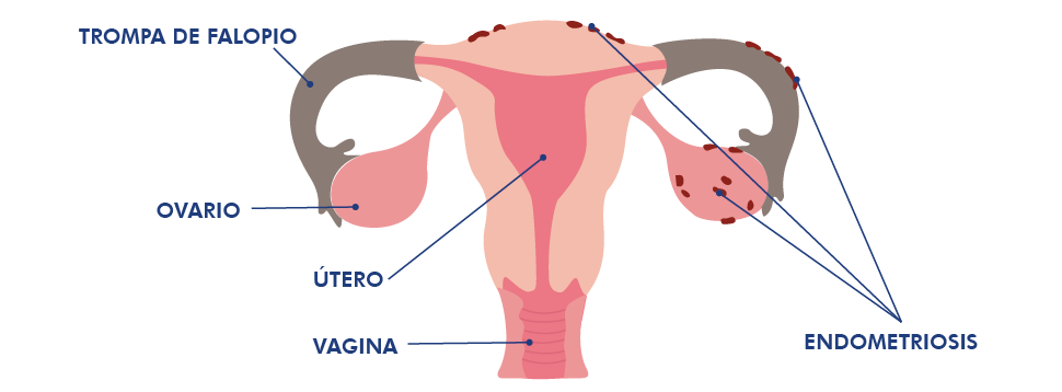 endometriosis-que-es