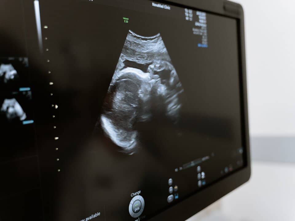 baby-ultrasound