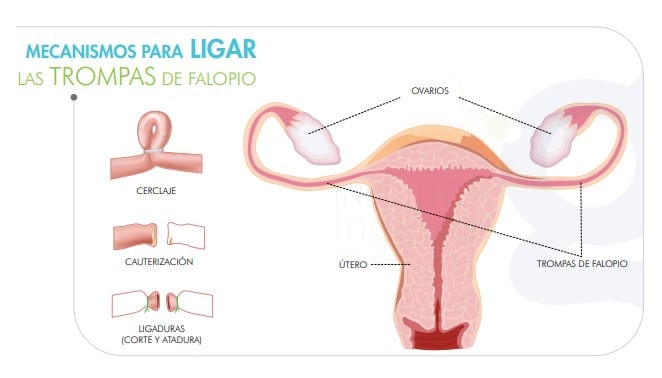  embarazo-con-salpingoclasia-es-posible-mecanismos-para-ligar-las-trompas-de-falopio