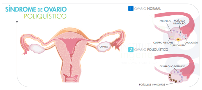 sindrome-de-ovario-poliquistico-segun-la-edad-de-la-mujer-imagn-de-ovarios-con-problema-de-sop-ovario-poliquistico