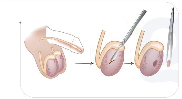 testicular-biopsy-to-detect-the-source-of-male-infertility-illustration-of-how-a-testicular-biopsy-is-performed