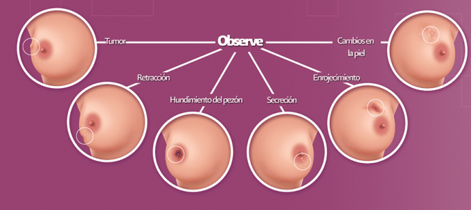 cancer-de-mama-y-fertilidad-guia-de-autoexploracion-de-mamas-y-tipos-de-alteraciones-en-ellas