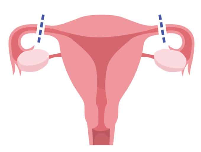 tubal-ligation-illustration