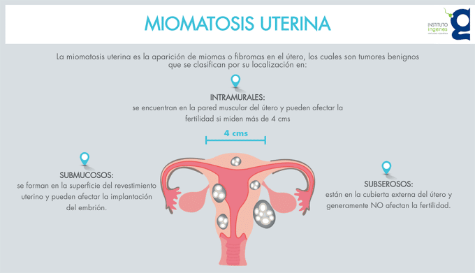 miomatosis-uterina-infografia-ingenes-tipos-de-miomas-uterinos-localizacion