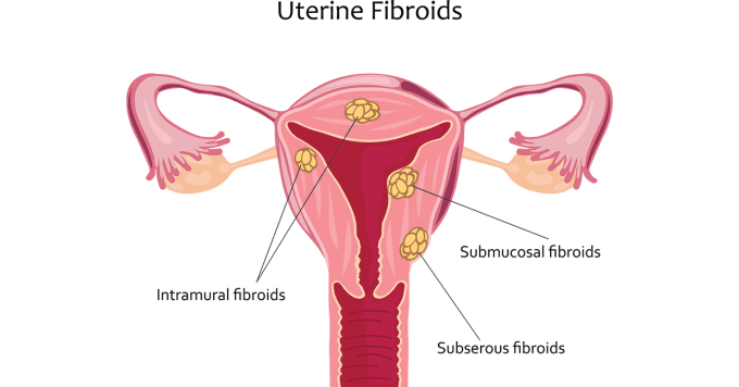 uterine-myomatosis-infografic–types-of-fibroids-location