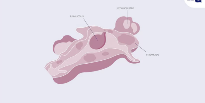 pelvic-adhesions