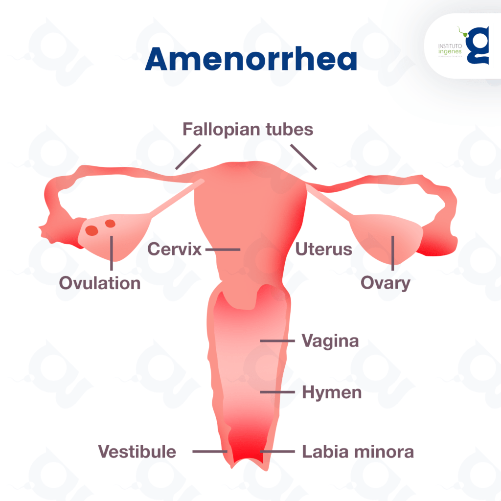 Amenorrhea: what is it and how does it affect fertility? Amenorrhea: what is it and how does it affect fertility?