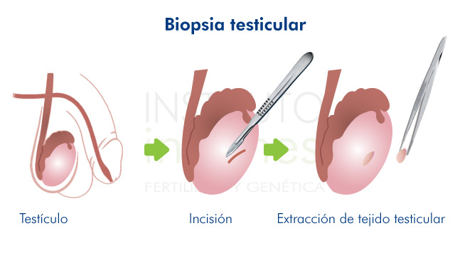 Biopsia Testicular