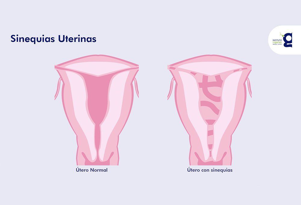sinequias uterinas