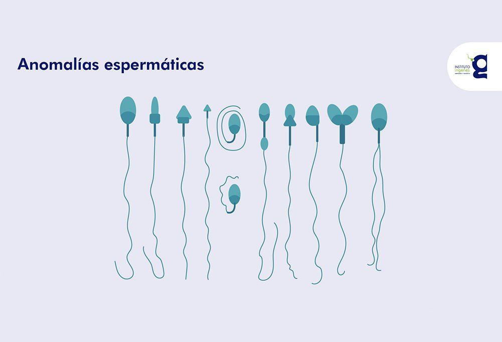 teratozoospermia-y-fertilidad-anomalias-espermaticas