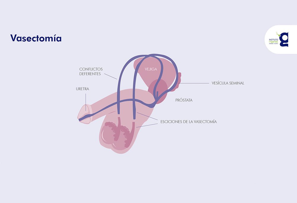 vasectomia-grafico-1